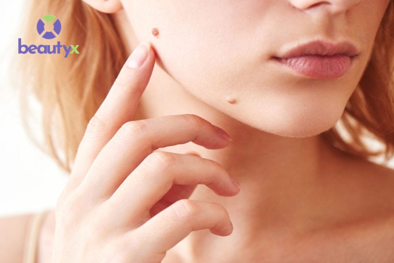 Nốt ruồi ở vị trí kém duyên trên gương mặt gây mất thẩm mỹ
